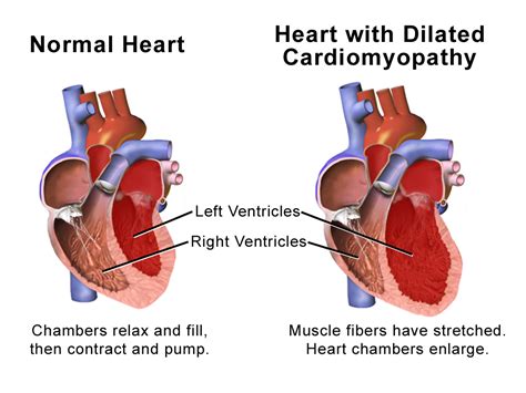 lv dilated means|common causes of dilated cardiomyopathy.